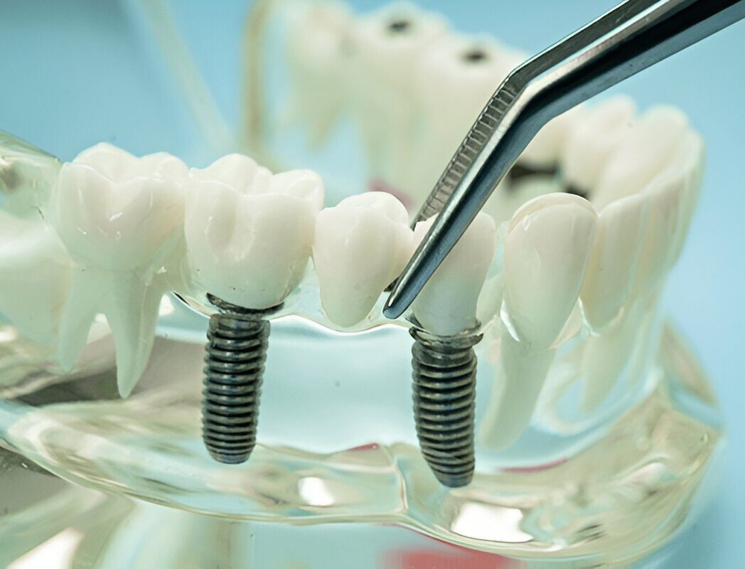Dental Implants Edmonton