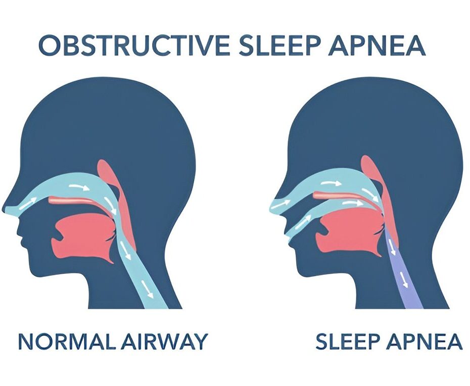 Sleep Apnea Edmonton