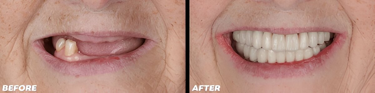 Tooth Implants Edmonton